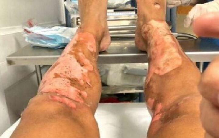 Gambe ustionate