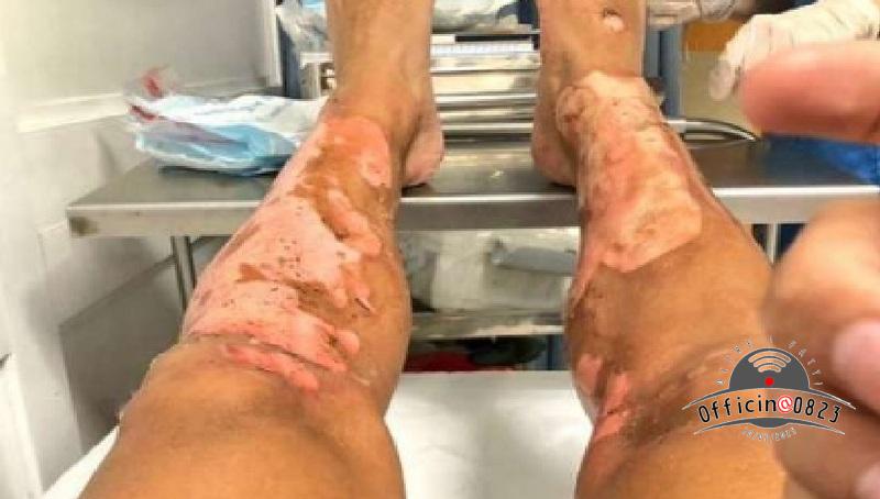 Gambe ustionate
